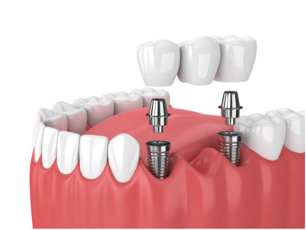 The Future of Dental Implants: Innovations and Trends